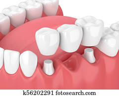 3d render of jaw with dental bridge 3d render of jaw with dental bridge