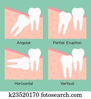 Wisdom Tooth Wisdom Tooth