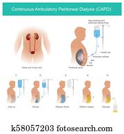 נמשך, ambulatory, פאריטונאיל, דיאליזה, capd