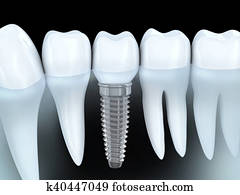 Dental implant Dental implant