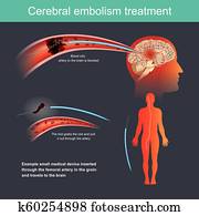 cerebraal, embolie, treatment.