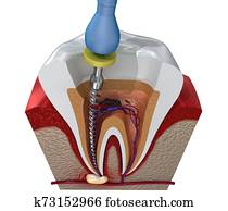 Root canal treatment process. 3D illustration Root canal treatment process. 3D illustration
