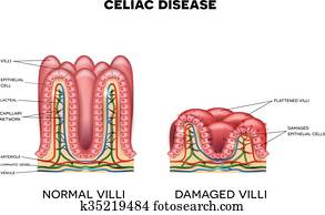 celiac, krankheit celiac, krankheit