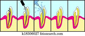 Root Canal Treatment Root Canal Treatment