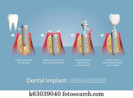 שיניים אנושיים, ו, של השיניים, השרש, וקטור, דוגמה
