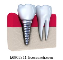 Dental implant Dental implant
