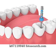 3d render of tooth with endodontic file in jaw 3d render of tooth with endodontic file in jaw
