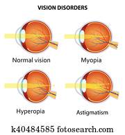 Common vision disorders. Common vision disorders.