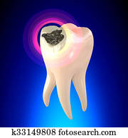 Tooth Molar with Dental Caries Tooth Molar with Dental Caries