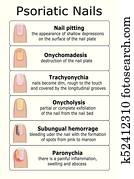 ilustration, של, psoriatic, ציפורניים