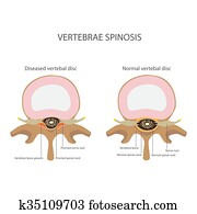 spin stenosis. vertebrae disease spin stenosis. vertebrae disease