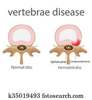 hernia. vertebrae disease hernia. vertebrae disease