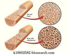 osteoporose