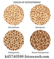 stadien, von, osteoporosis. stadien, von, osteoporosis.