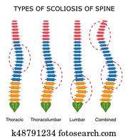 סוגים, של, עקמת חוט השידרה, של, spine.