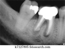 x ray of molars x ray of molars