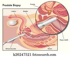 ערמונית, ביופסיה