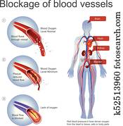 סתימה, של, דם, vessels.