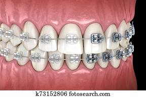 Teeth with metal and Clear braces in gums. Medically accurate dental 3D illustration Teeth with metal and Clear braces in gums. Medically accurate dental 3D illustration
