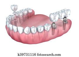 3d lower teeth and dental implant transparent render isolated on white 3d lower teeth and dental implant transparent render isolated on white