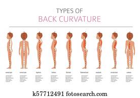 arten, von, back, curvature., medizinische, desease, infographic arten, von, back, curvature., medizinische, desease, infographic