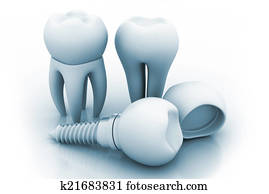 Dental Implant Dental Implant