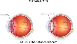 Cataracts Cataracts