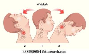 whiplash injury whiplash injury