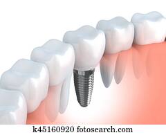 dental, implante