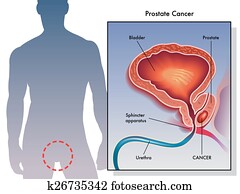 Prostate Cancer Prostate Cancer