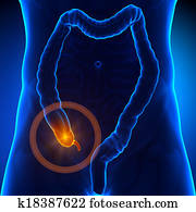 תוספתן, כאב