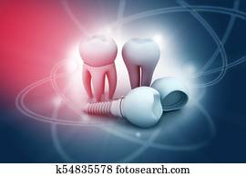 Dental implant Dental implant