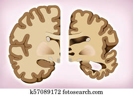 插圖, 大約, the, 區別, 在之間, a, 健康, 腦子, 以及, 另一個, 由于, alzheimer's.
