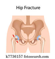 Hip fracture, eps8 Hip fracture, eps8