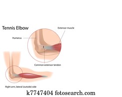 טניס, elbow,, eps8