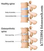 וסטאוארטריטיס, של, ה, spine,, eps8