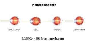 Vision disorders Vision disorders