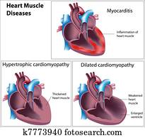 מחלות, של, לב, muscle,, eps8