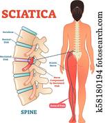 נשית, בריאות רפואית, דאג, וקטור, דוגמה, תרשים, זמום, עם, יותר נמוך, עמוד שדרה, ו, עצב ירכי, כאב, ב, leg.