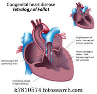 Tetralogy of Fallot, eps8 Tetralogy of Fallot, eps8