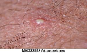 Ingrown Hair Closeup Stock Photography K50296145 Fotosearch