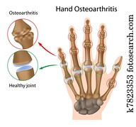 osteoarthritis, közül, a, kéz, eps8