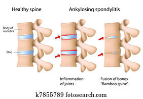 ankylosing, spondylitis, של, ה, עמוד שדרה