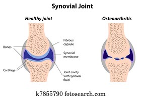ממשחי, מפרק, נורמלי, ו, דלקת המפרקים