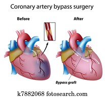 Heart bypass surgery, eps8 Heart bypass surgery, eps8