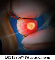 prostate cancer prostate cancer