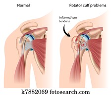 כתף, ימפינגאמאנט, ,, eps8