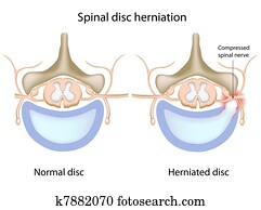 של השדרה, דיסק, herniation,, eps8