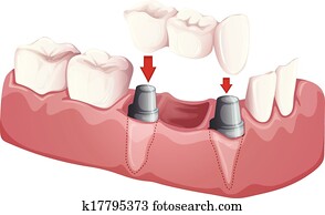 dental, ponte