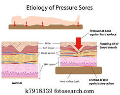 אטיולוגיה, של, לחץ, sores,, eps8